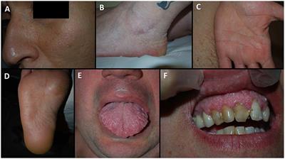 PTEN Hamartoma Tumor Syndrome: Skin Manifestations and Insights Into Their Molecular Pathogenesis